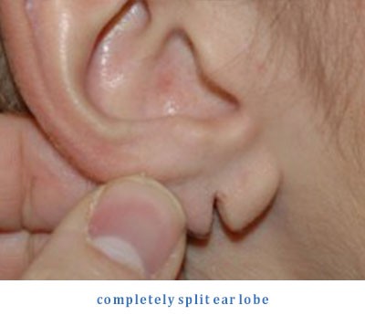 split-earlobe-1