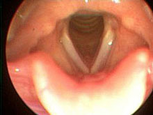 normal vocal cords